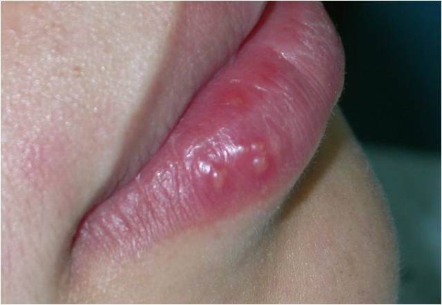 发热,口腔多发损害.  (2)唇疱疹:多发生唇红及临近皮肤.